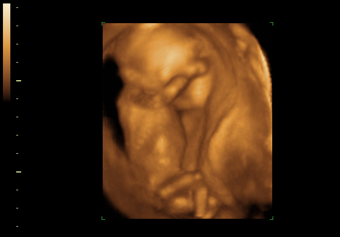 3D ultrasound image at 17 weeks